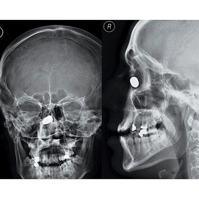 Bullet-proof nose?!