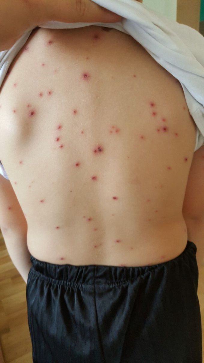 Red Marks All Over Baby Body