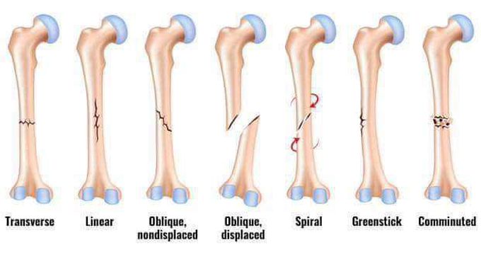 Types of fracture