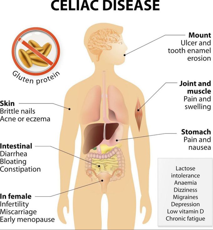 celiac-disease-medizzy