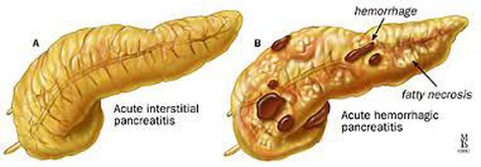 Causes of pancreatitis