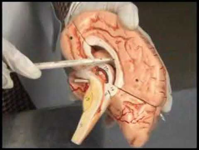 Ventricle of brain