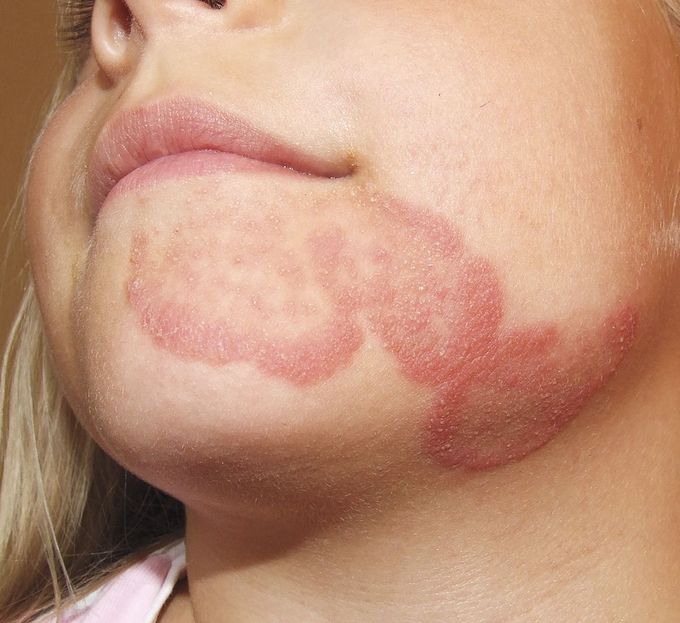 Tinea Faciei