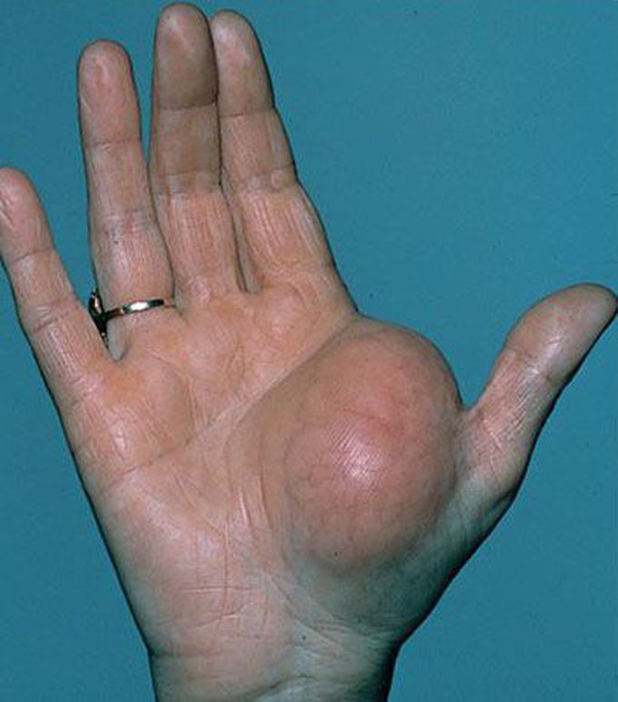 Lipoma