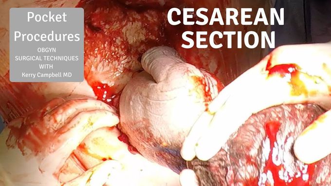 Cesarean Section; OBGYN Surgical Techniques with Dr. Kerry Campbell, MD