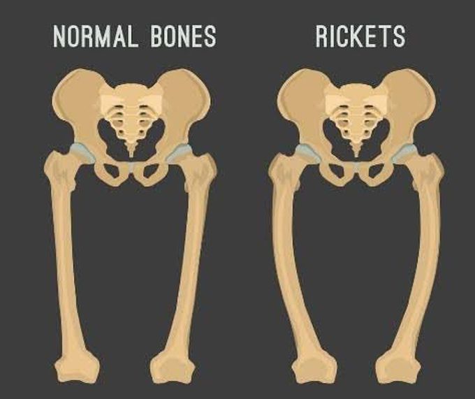 causes of rickets