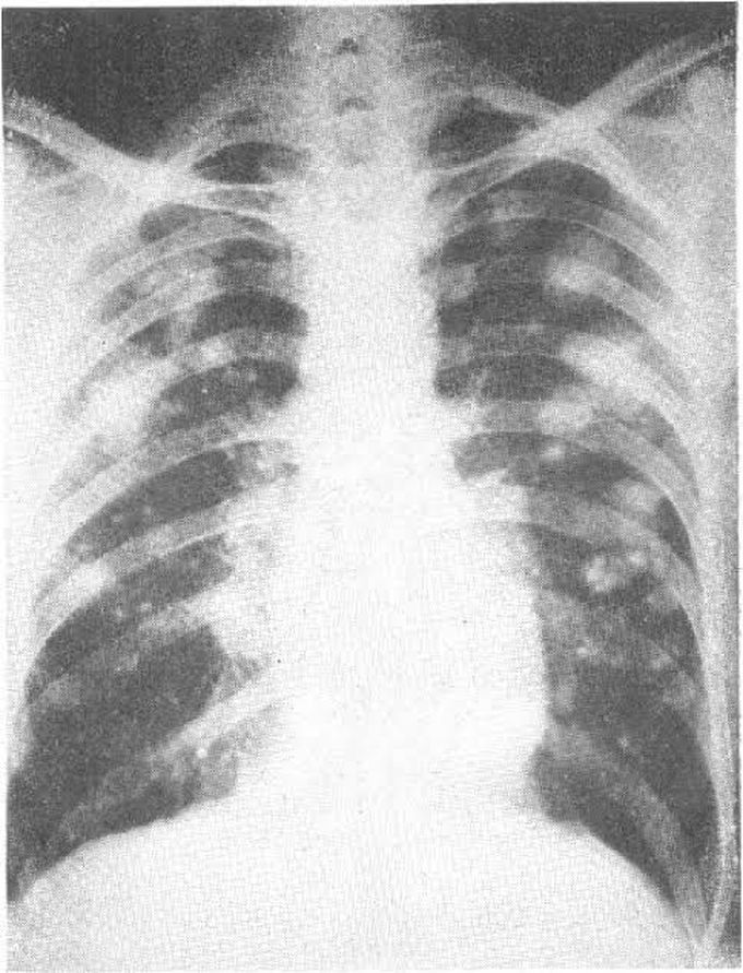 Causes of caplan syndrome