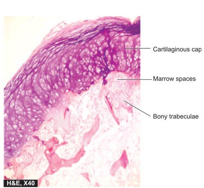 Osteochondroma