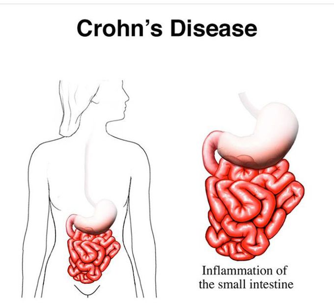 Colon disease - MEDizzy