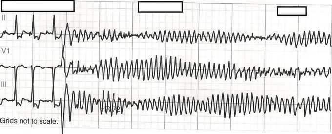 Drugs That Can Cause Torsades De Pointes