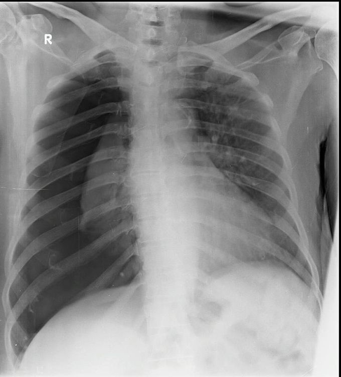 Spontaneous right pneumothorax without fall in saturation