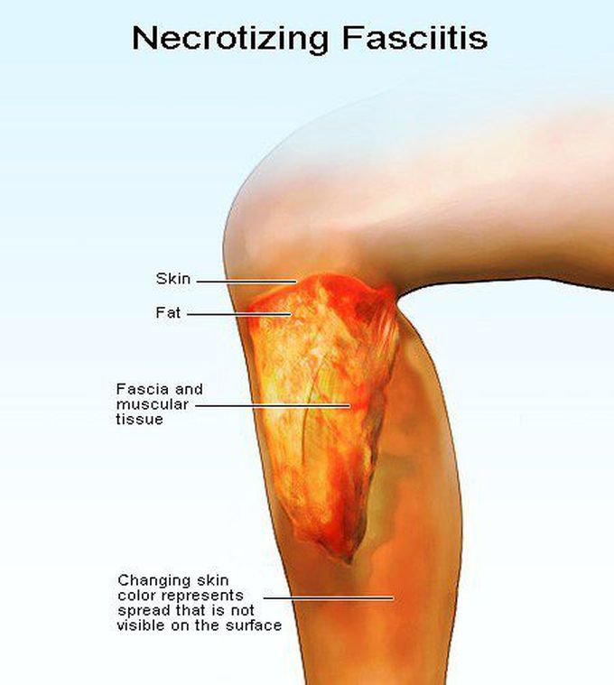 Necrotizing Fascitis