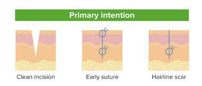 Primary intention of healing