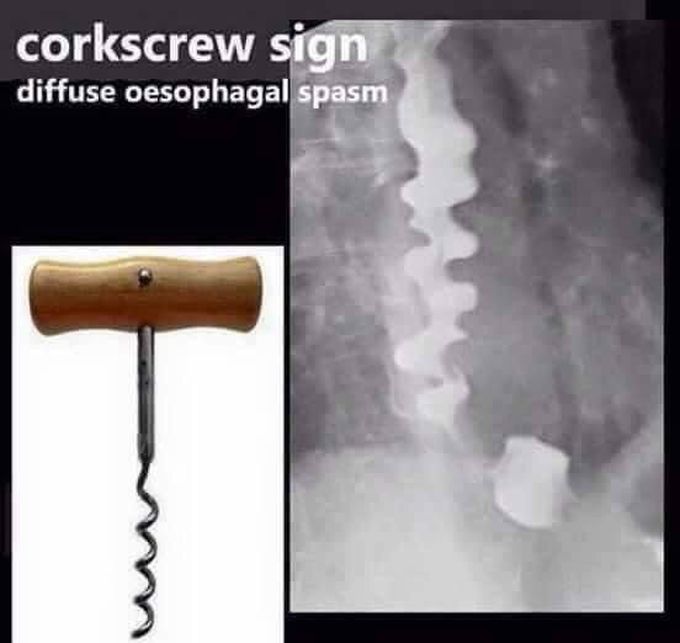 Diffuse Esophageal spasm Radiography