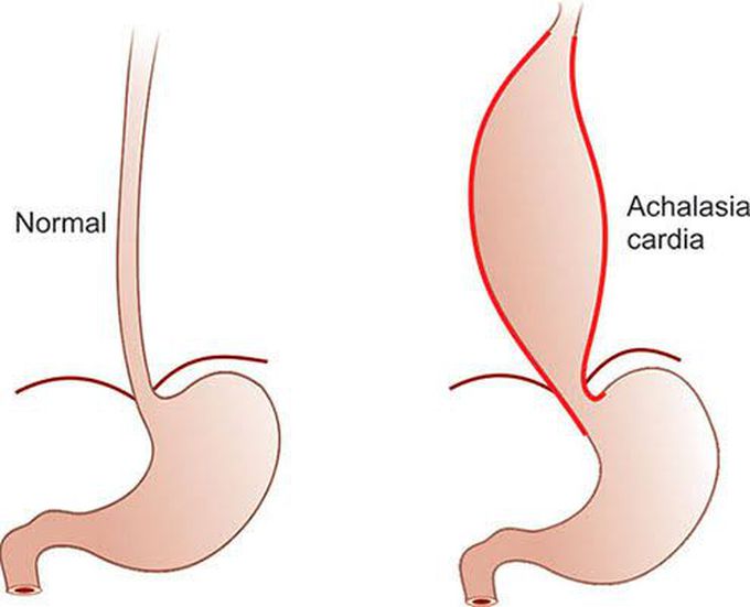 Symptoms of achalasia