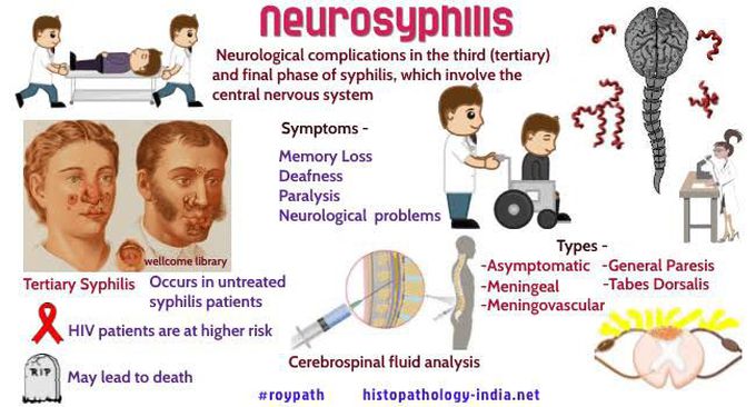 Neurosyphilis