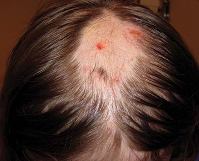 Treatment of hair pulling disorder