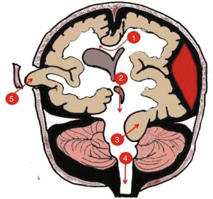 herniation secondary to raised ICP