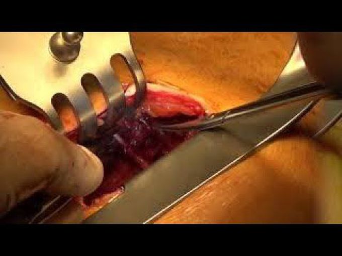 Off-Pump LIMA to LAD Coronary Artery Bypass Through Left Anterior Minithoracotomy