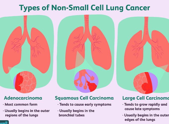 Types of Non-Small Cell Lung Cancer
