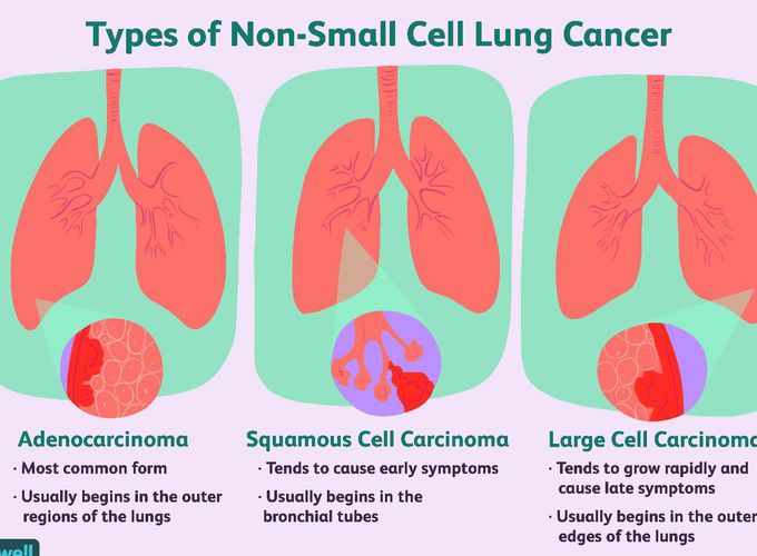 Types of Non-Small Cell Lung Cancer - MEDizzy