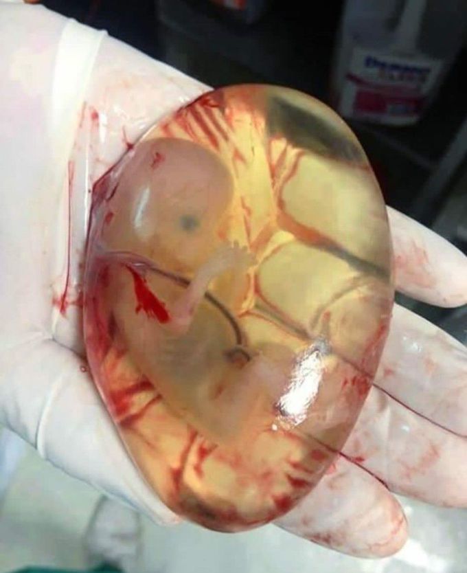 Fetus