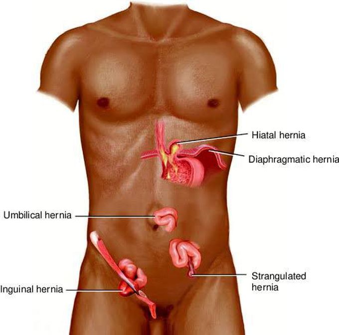 Hernia