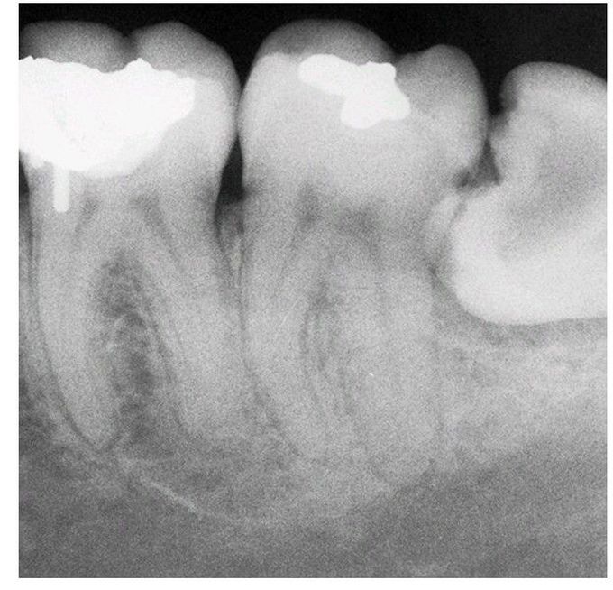 Impacted 3rd molar