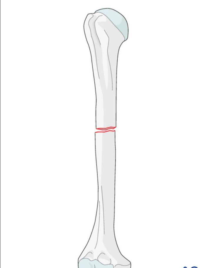 transverse fractures