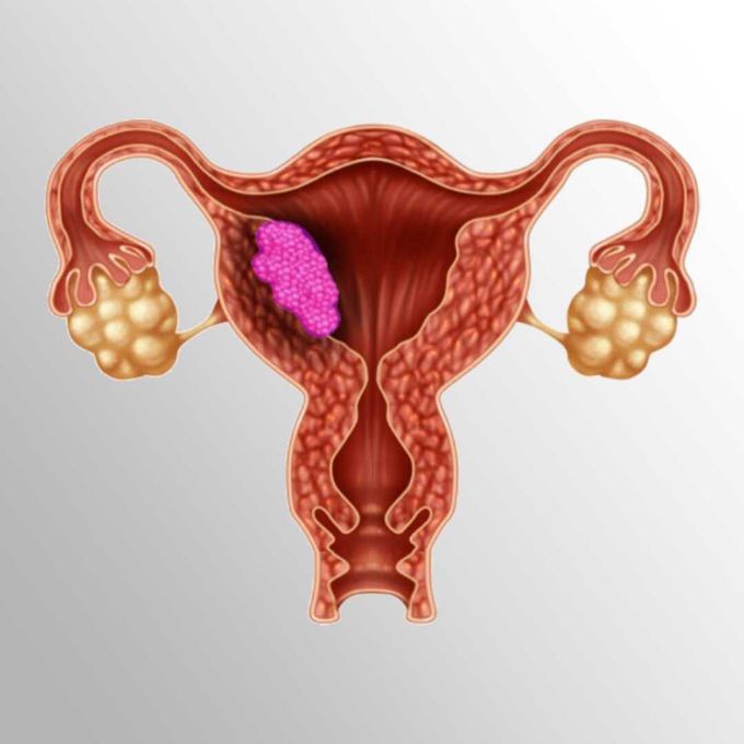 Womb (uterus) cancer