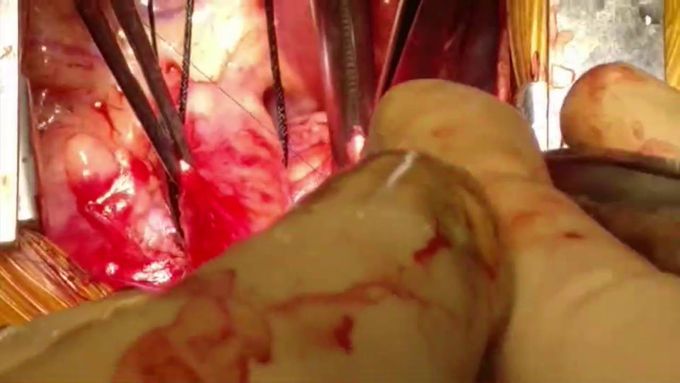 Rare Case of Vascular Sling With Left Main Bronchus Compression
