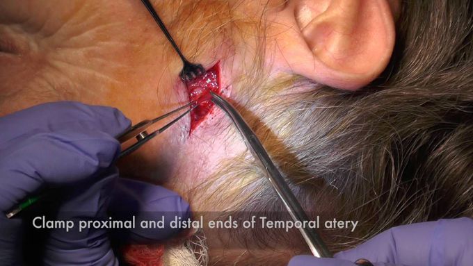 Technique and Indications of Temporal Artery Biopsy