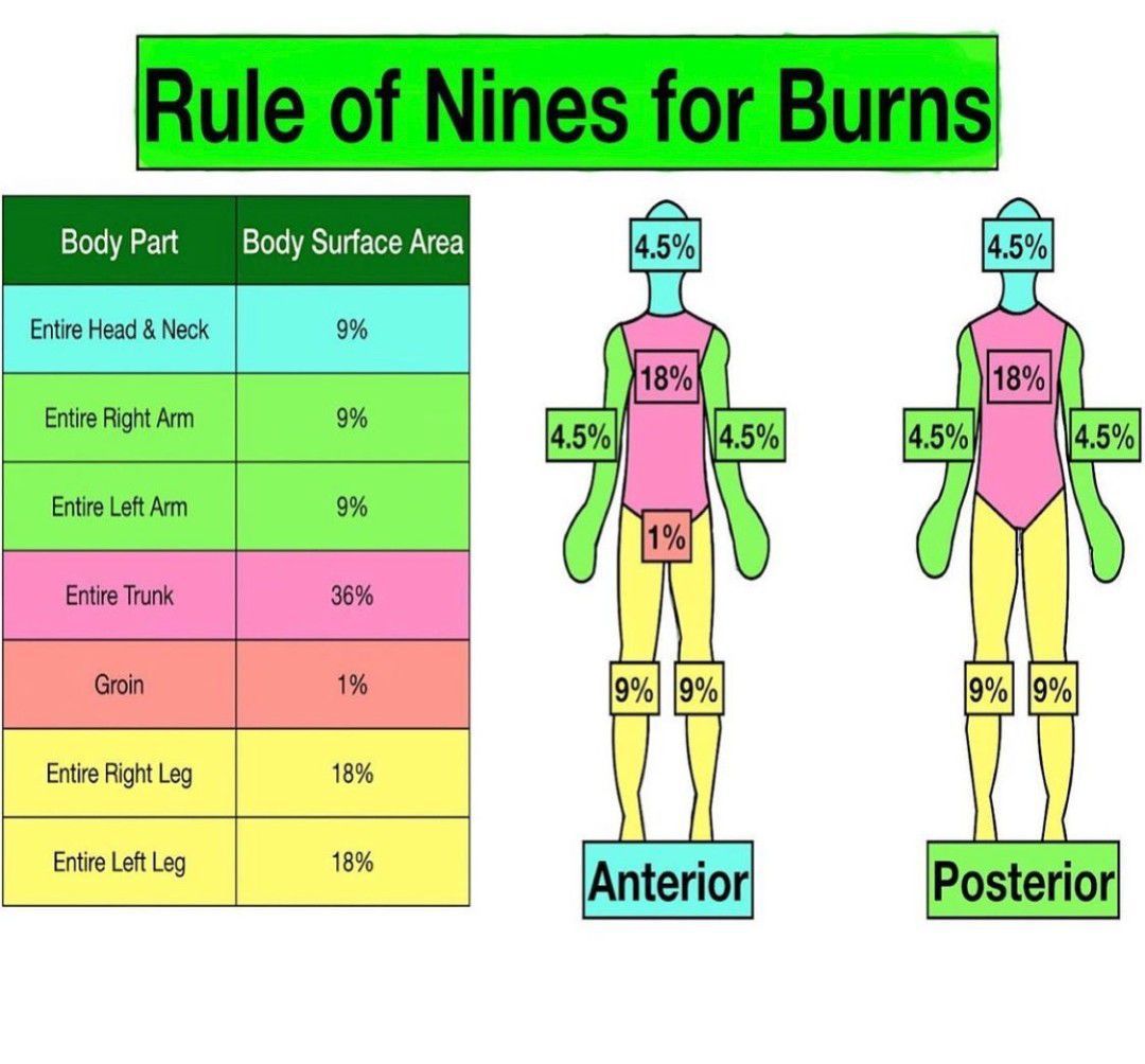 Rule Of Nines Burn Chart Children - Ponasa