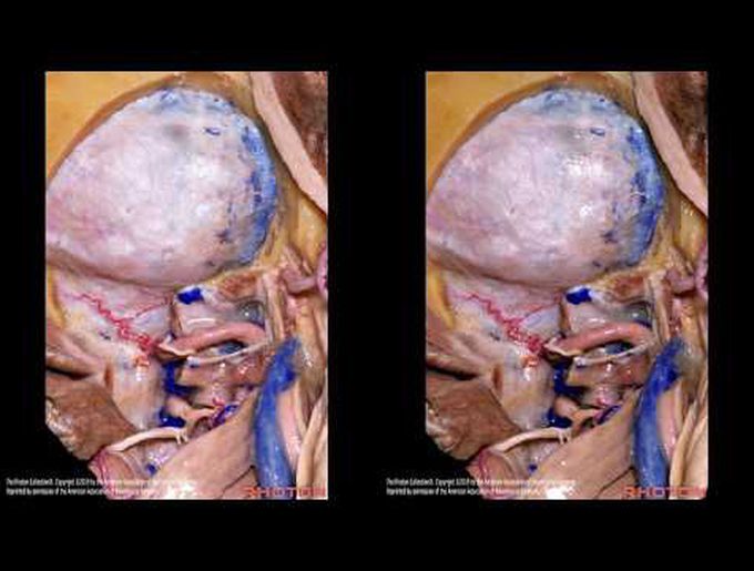 Microsurgical resection of foramen magnum meningioma thru a transcondylar approach: 3D operative vid
