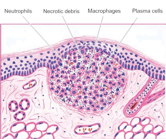 Abscess