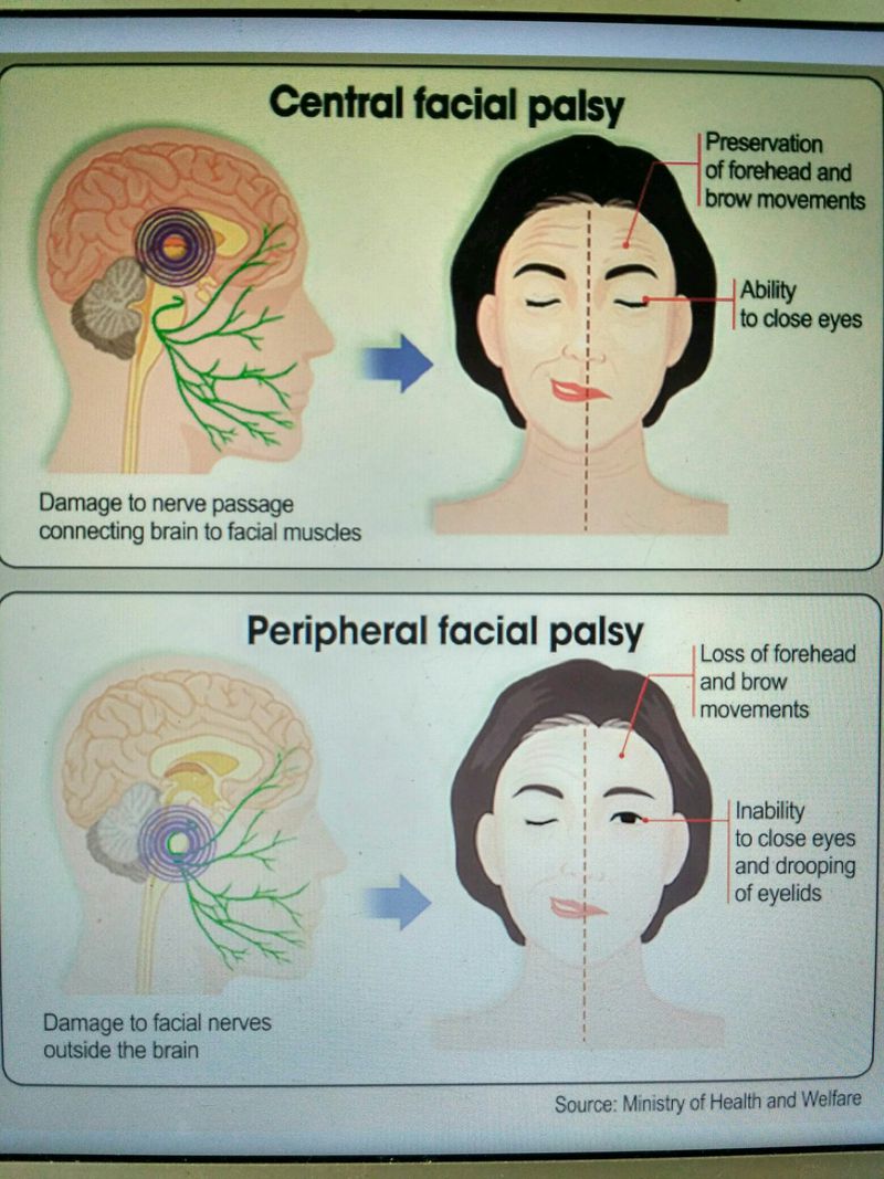 facial-palsy-expert