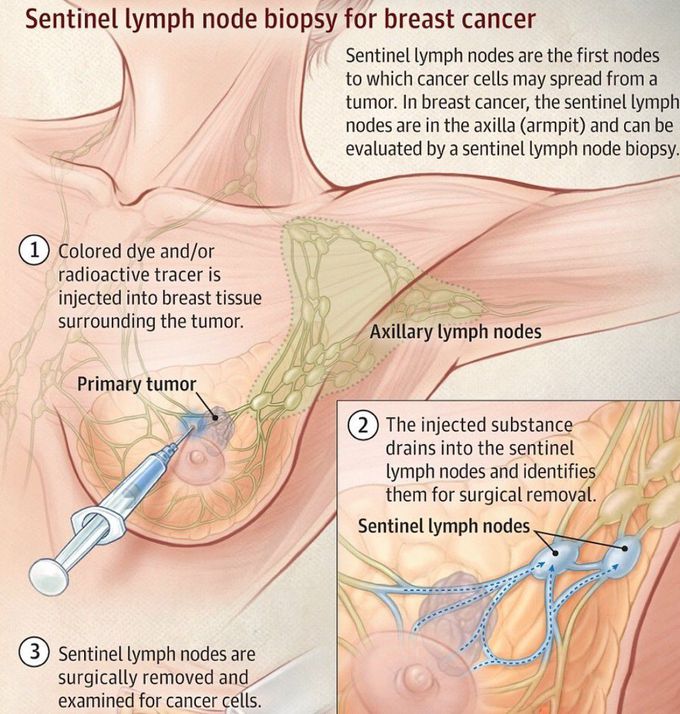 Lymph node biopsy for breast cancer