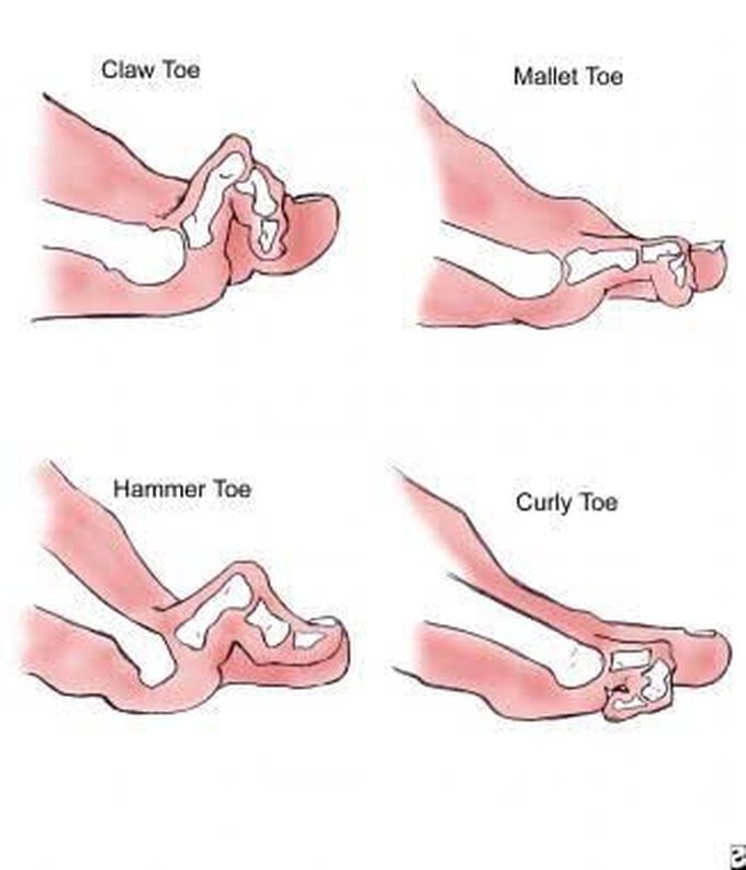 Symptoms of mallet toe