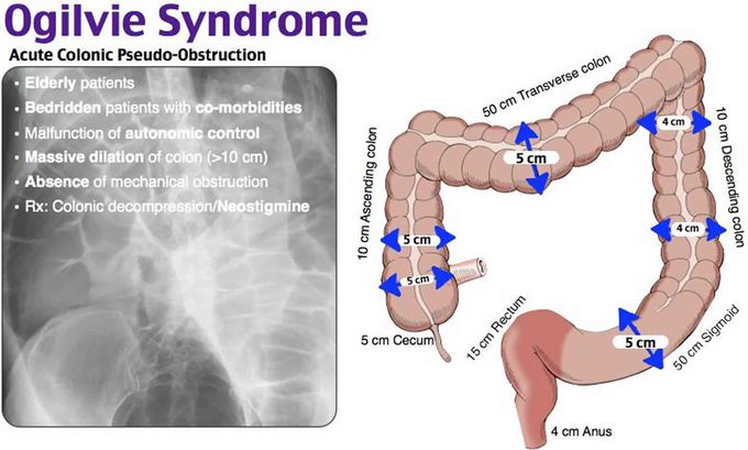 Ogilvie Syndrome