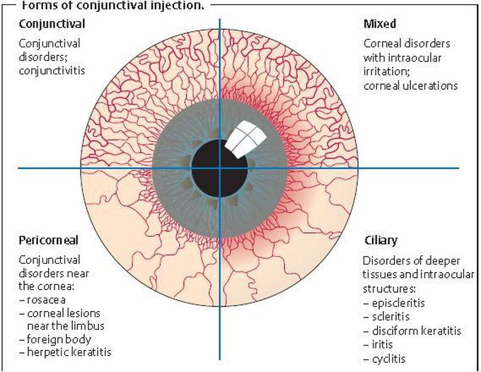 Forms of conjunctival injection