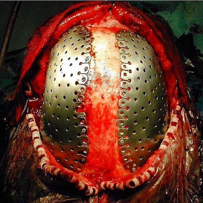 Cranioplasty