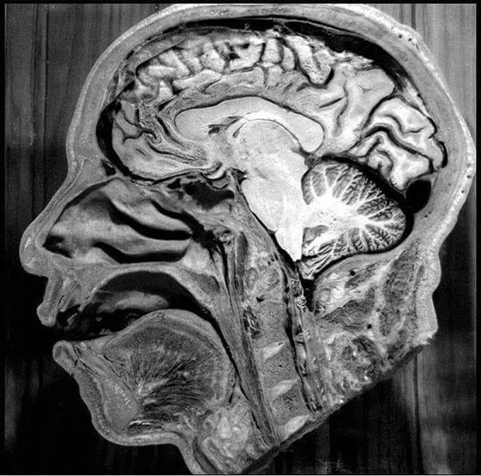 Sagital brain cutting