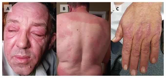 Dermatomyositis