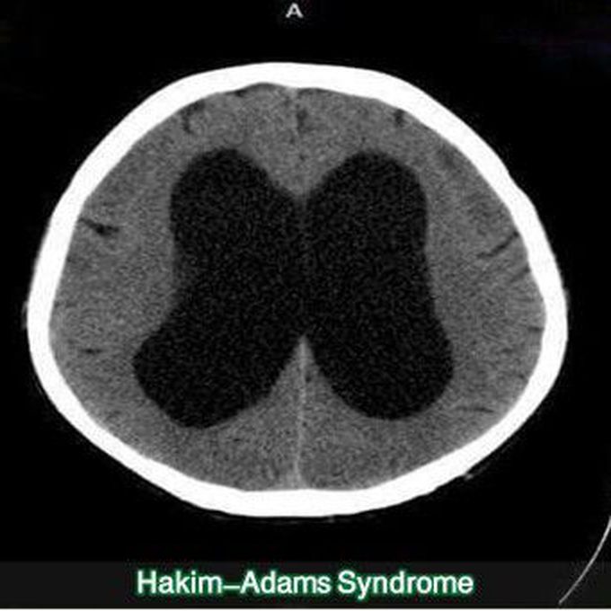 Hakim -  Adams Syndrome