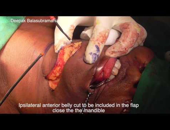 submental flap