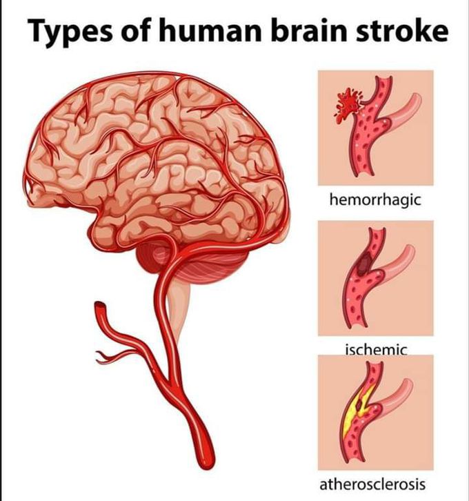 Stroke occurs when an artery to the brain become blocked or ruptures, resulting in death of an area of brain tissue due to loss of it's blood supply(cerebral infection)and causing sudden symptoms.there are two types of stroke..
Ischemic stroke
Hemoerrhgic stroke