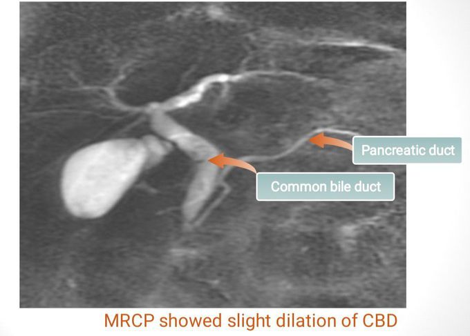 MRCP Results