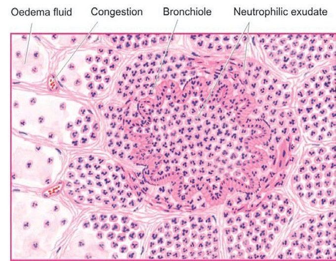 Bronchopneumonia