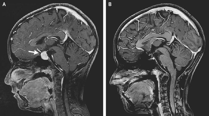 Pituitary Hyperplasia from Primary Hypothyroidism