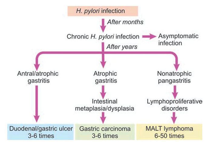 H pylori gastritis